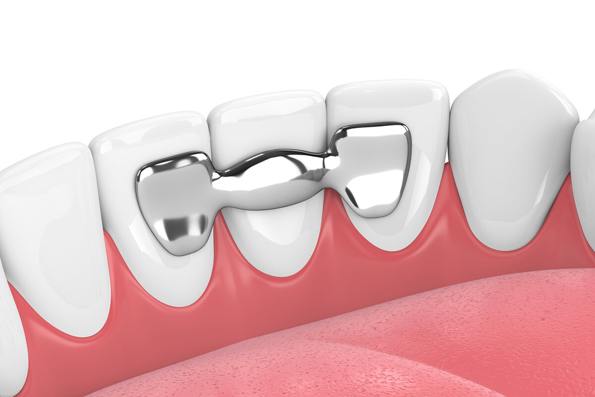 Image showing a new dental bridge discussing Common issues with dental bridges.
